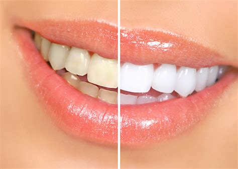 Teeth Whitening Treatment - Stag Lane Dental Centre