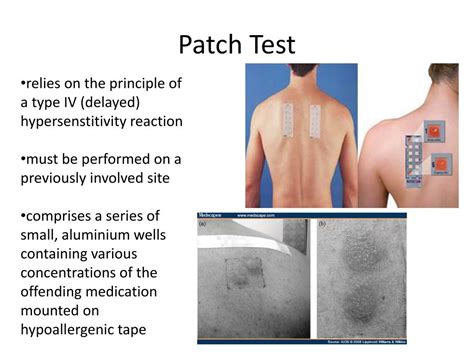 PPT - Patch Test PowerPoint Presentation, free download - ID:2244373