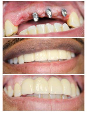 front teeth dental implants