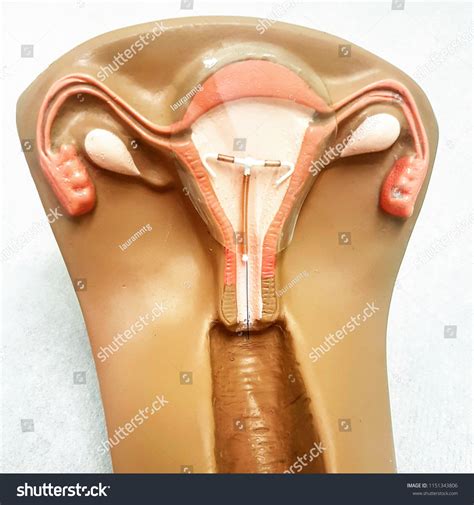 Contraceptive Copper Iud Birth Control Copper Stock Photo 1151343806