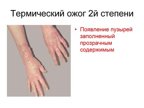 Ожоги, отморожения, электротравма - презентация онлайн