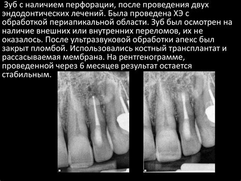 Микрохирургическая эндодонтия - презентация онлайн