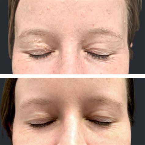 Extraction Facials | Blackhead Extraction, Milia, Pore & Pimple Extraction