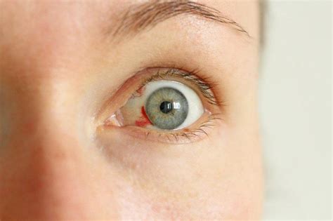 What Causes Bloodshot Eyes? | OasisEye Specialists