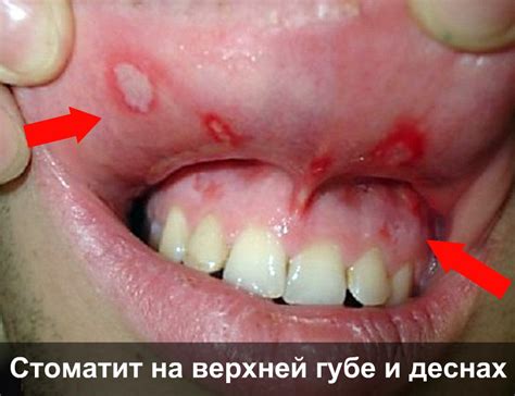 Мозоль на губе, во рту у новорожденного или взрослого: почему возникает ...