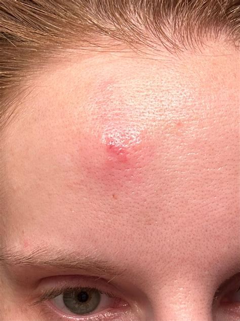 Staph?? Infection? | BabyCenter
