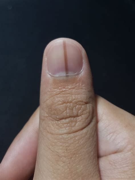 Dark Line on Fingernail : r/Melanoma