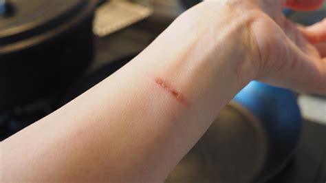 effective home remedies  minor burns simple solutions  soothe