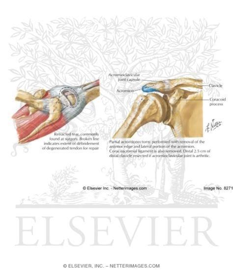 Acromioplasty