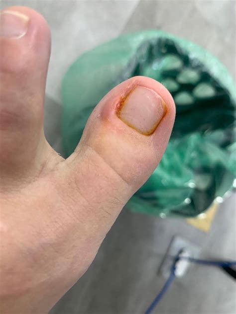 Unha encravada em Jundiaí, SP | Classificados - Solutudo