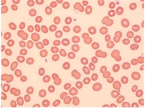 Anemia Peripheral Blood Smear