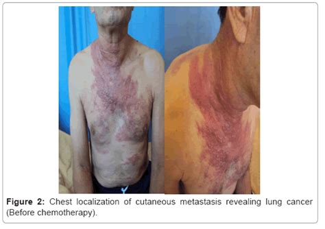 Skin Cancer Metastasis