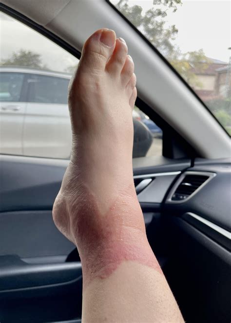 Can allergic reaction to taping be this bad? (10 days after) : r/skin