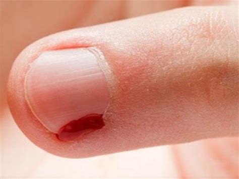 Заусенец на пальце нарывает и палец опух: чем лечить заусенец, который ...