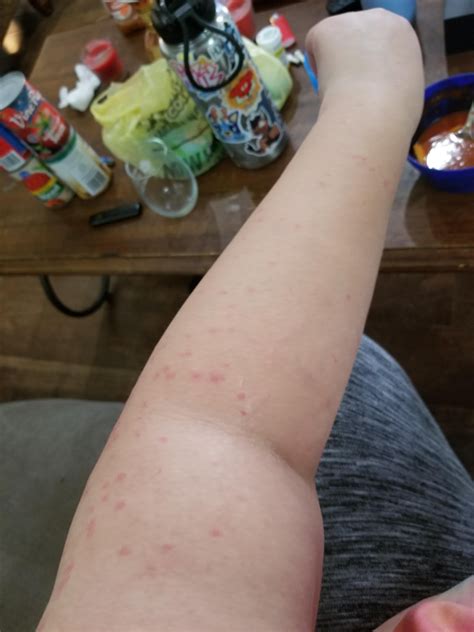 Red dots all over arms and legs : r/DermatologyQuestions