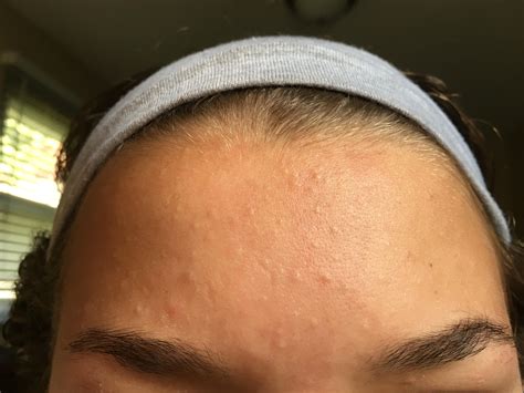 bumps on face how to remove 10