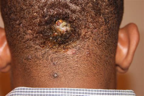 Scalp Keloids - Scalp Keloid Removal Expert - New York
