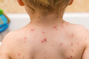 Paediatrics: managing chickenpox in children | Emergency Live