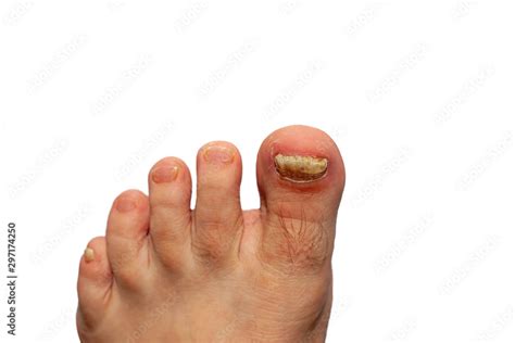 how to file toenails with fungus