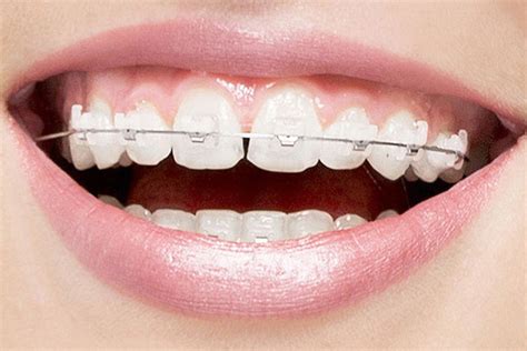 Are Clear Braces a Popular Option for Teeth Straightening? - Palm Beach ...