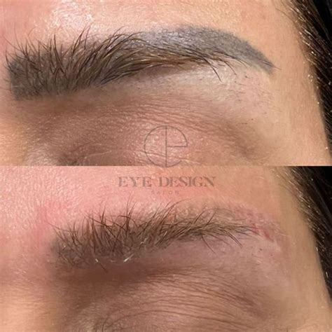 Eyebrows tattoo removal - definition, cost, and benefits