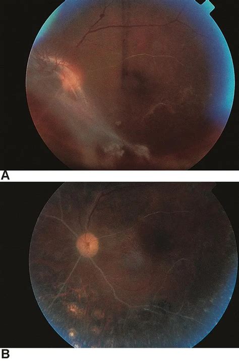 Retinal ischemia - American Academy of Ophthalmology