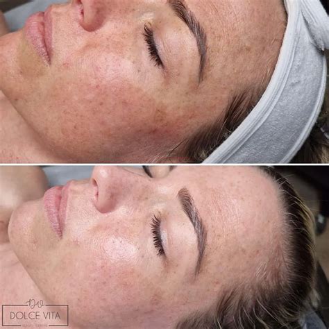 Everything You Need to Know About Azelaic Acid Peel
