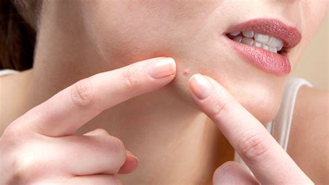 Pimple Popping Titans Watch The Legends Of Extraction