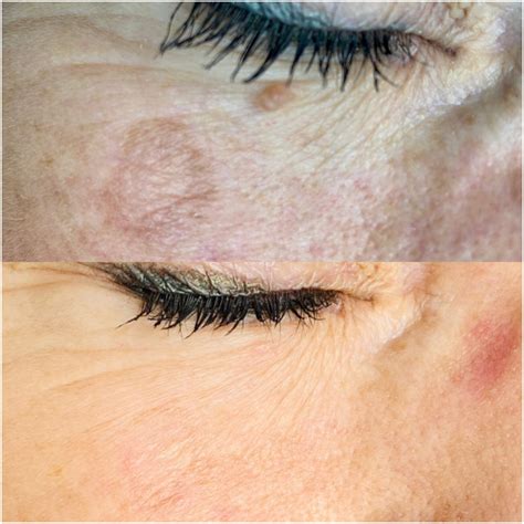 Say Goodbye to Facial Lesions: Treatments and Solutions Unveiled - The