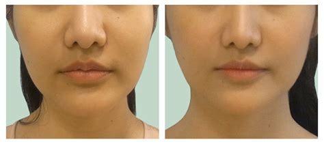 Lip Reduction Surgery-Facts, Risks and Procedure - STORY HIPPO