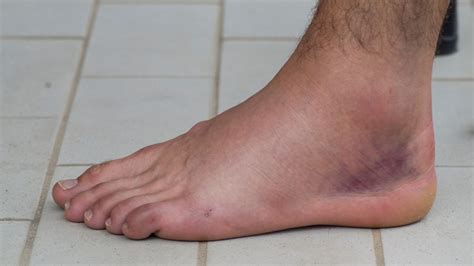 How Long Does a Sprained Ankle Stay Swollen | Grades & Tips