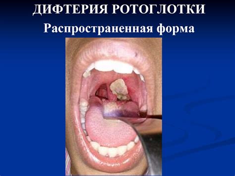 Дифтерия - презентация онлайн