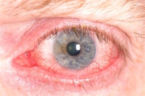 Eye Redness: Causes, Symptoms & Complications