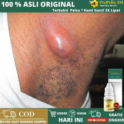 jual obat penghancur benjolan lipoma obat penghancur benjolan lipoma