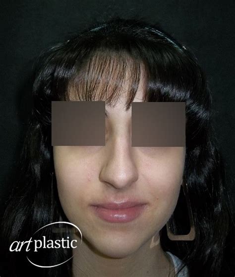 Большой, горбатый нос / Фото / Альбом №59 | Клиника Art-Plastic
