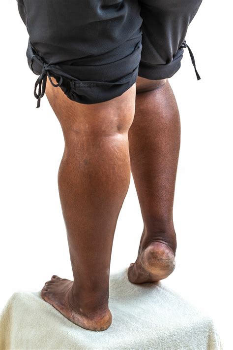 Osteoarthritis Knee Symptoms | Osteoarthritis Symptoms - AKPC