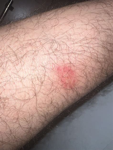 New rash : r/bugbites
