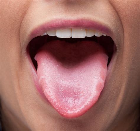Tongue Disorders: MedlinePlus