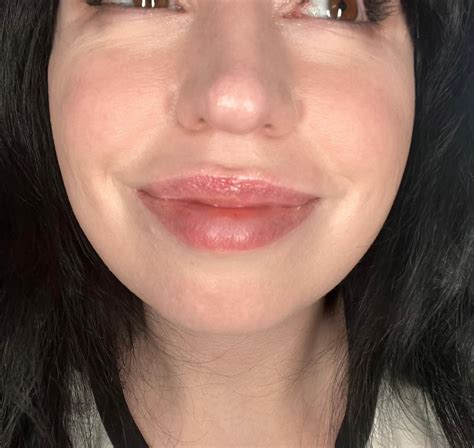Botox or filler with these under eye lines??? : r/30PlusSkinCare