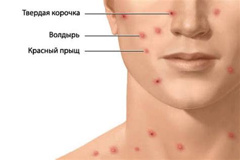Ветряная оспа, коварная и опасная... - Статьи - Сайт БУЗ ВО "ВО ЦОЗМП"