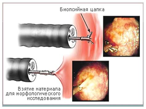 Биопсия. Хорион бүрлерінің биопсиясы - презентация онлайн
