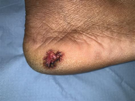 Long-Standing Non-Healing Ulcers on the Sole of the Foot: The