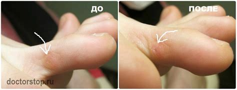 Мозоль на пальце ноги: как лечить сухие мозоли на пальцах в домашних ...