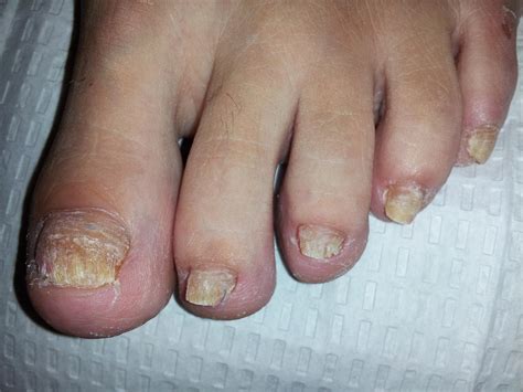 Laser Fungal Nail Treatment - Bios Pics