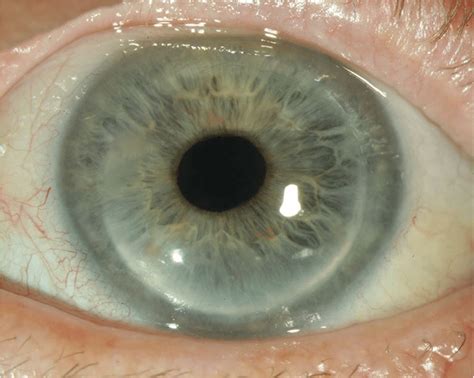 left eye pkp  performed   patient   years