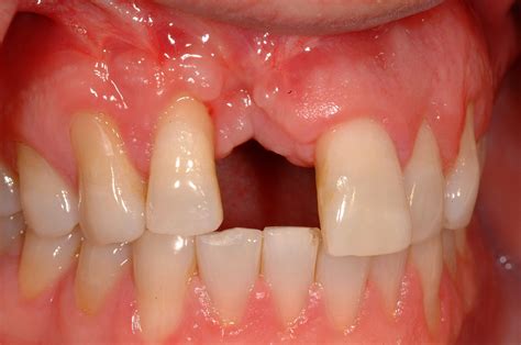 Bone Graft For Dental Implant What You Need To Know - vrogue.co