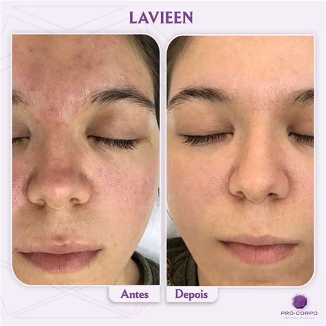 Lavieen Antes E Depois Olheiras - Laser Lavieen Thulium | Tudo Que Você Precisa Saber.