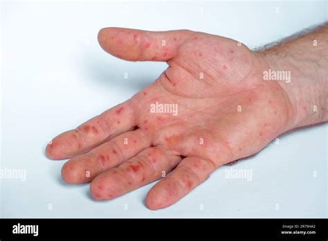 Shingles On Palms Of Hands