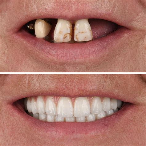 Turkey Teeth: Achieve Your Perfect Smile with Dentaressmile