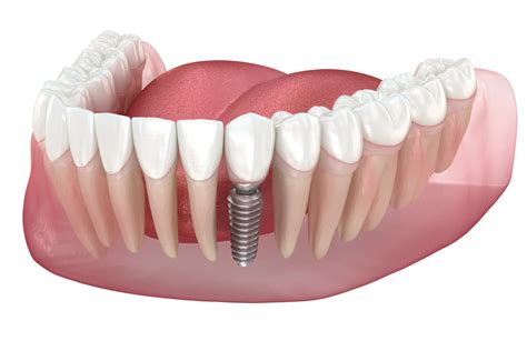 Honest Dental Implant Reviews & Patient Experiences